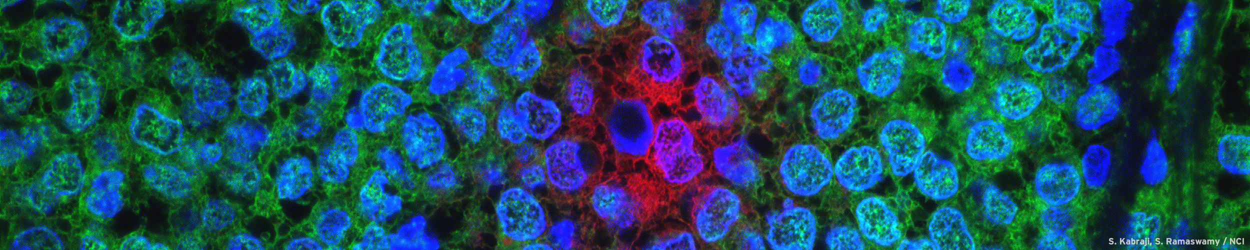Treatment-Resistant Breast Cancer Cells